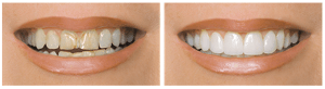 Restore-Chipped-Teeth