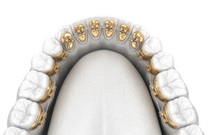 Lingual braces system